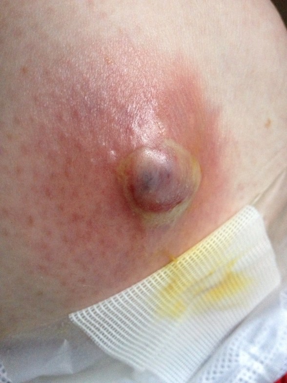  Abscess