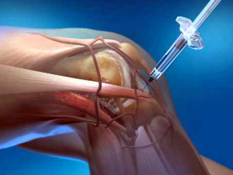 Knee Aspiration